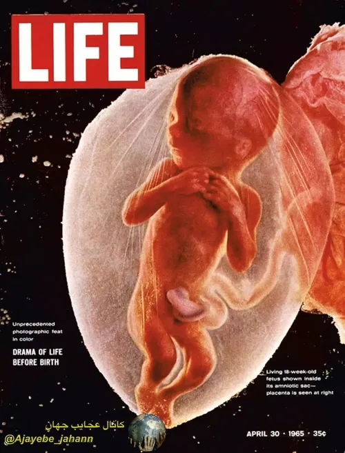 اولین تصویری که از یک جنین زنده (18 هفته ای) درون رحم ماد