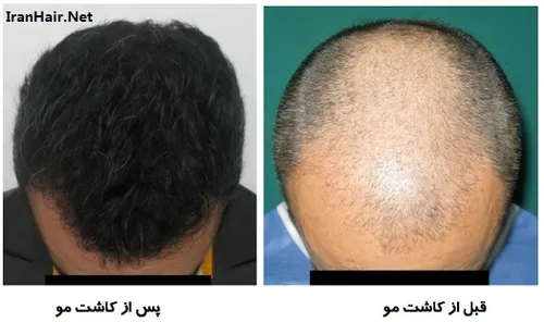 کاشت مو به روش غیر جراحی FIT در این روش برداشت فولیکول ها