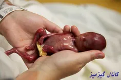 جنین سه ماهی که بعد از بدنیا اومدن زنده موند.:-o