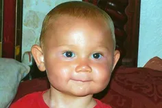 پوست بدن #لئون پسر بامزه ی چهارساله در #انگلیس به دلیل دا