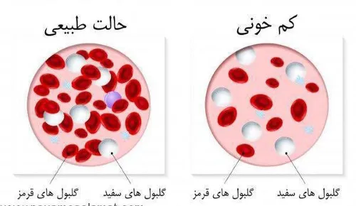 ♎ چطور بفهمیم کمخونی داریم