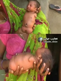 زن جوان هندی پس از زایمان با دیدن نوزاد بدون دست و پا بهت