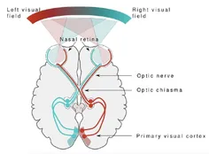 تراشه نورالینک ایلان ماسک و افراد نابینا