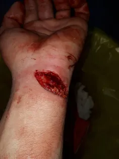اسداسماعیلی در یک حادثه کاری مچ دستش با دستگاه برش برخورد