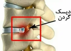 ✅ علایم #دیسک_گردن👇
