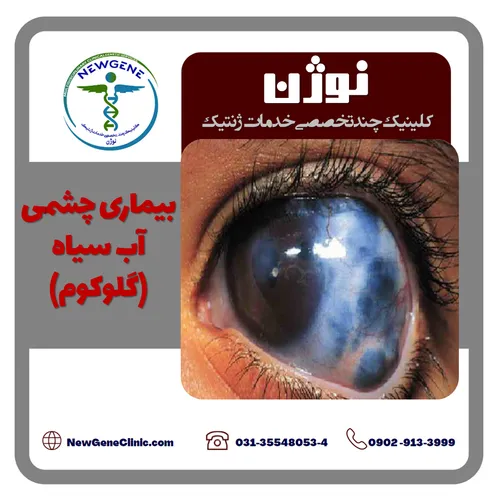 بیماری چشمی آب سیاه (گلوکوم) چیست؟