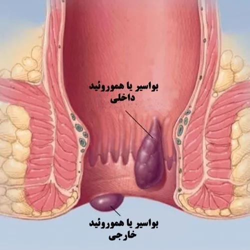 بواسیر، دلایل آن، راه درمان، در لینک زیر 👇👇👇