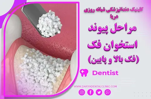 مراحل پیوند استخوان دندان ( فک بالا و پایین )