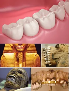 در مومیایی های بدست امده از مصر اثری از دندان های خراب مش