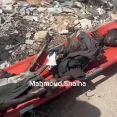 ⬅️ صحنه ای دلخراش از جسد سوخته ی یک کودک فلسطینی در بیمار