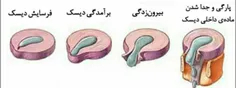 دیسک کمر از ۳۶ لایه ساخته شده است که اگر تمام ۳۶ لایه پار