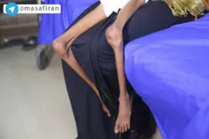 پاهای دختر ١٢ ساله‌ی #یمنی ...