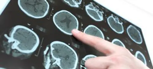 محققان آزمون تعادل را برای پیش بینی خطر سکته مغزی معرفی ک