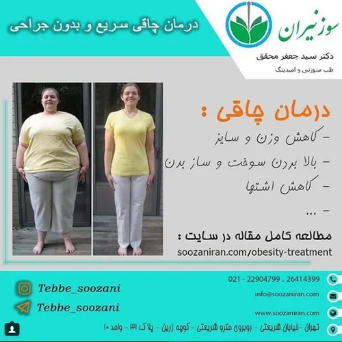 درمان چاقی با طب سوزنی