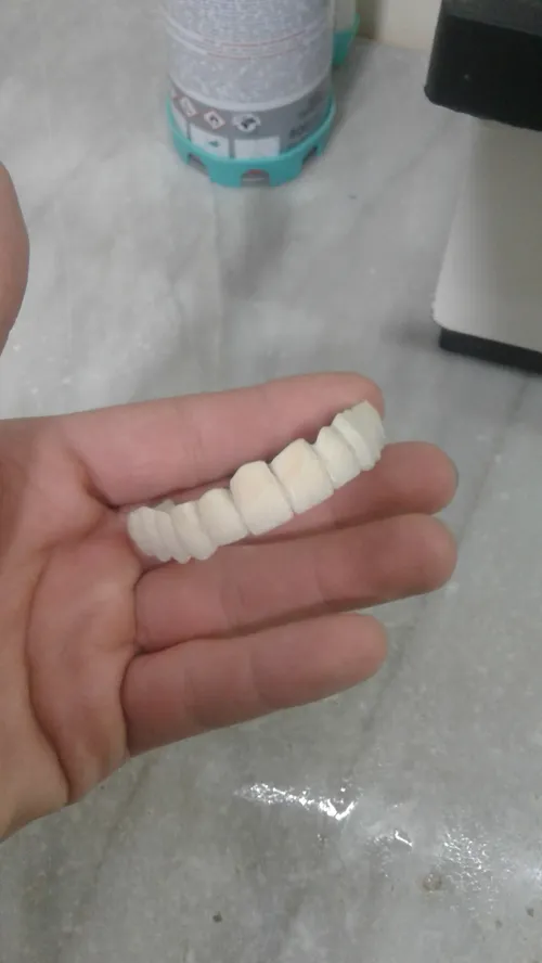 روکش دندان pfm