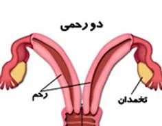 برخی زنان دو رحم دارند