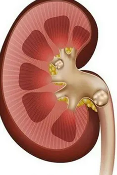 📜 درمان سنگ کلیه