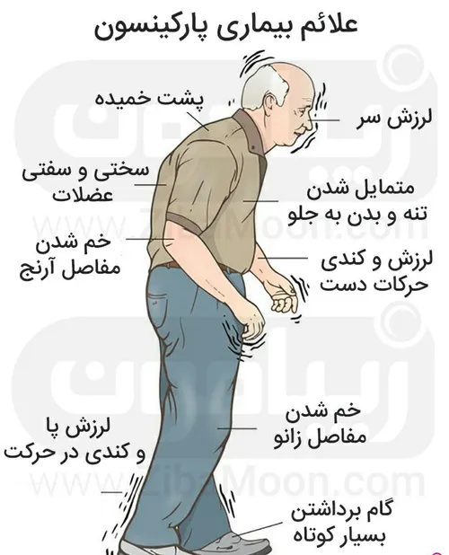 پارکینسون یک بیماری مزمن پیش رونده است یعنی برای مدت زمان