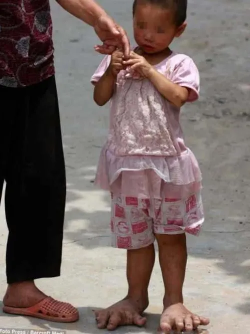 دختری با پاهای عجیب یک دختر بچه 3 ساله چینی از یک بیماری 