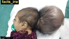 نوزادی عجیب با 2 سر بدنیا آمد:نوزادی با دو سر اگرچه خوابی