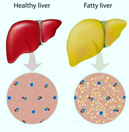 کبد چرب در حالت کلی و در درجه اول شرایط بحرانی نیست، مراح