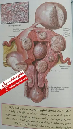 💢 تصویری از #فیبروم رحمی