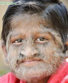 پسر بچه هندی که دچار یک سندرم بسیار نادر به نام"hypertric