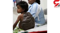 دیدیر پسربچه ۶ ساله کلمبیایی با یک ضایعه خیلی بزرگ روی کم