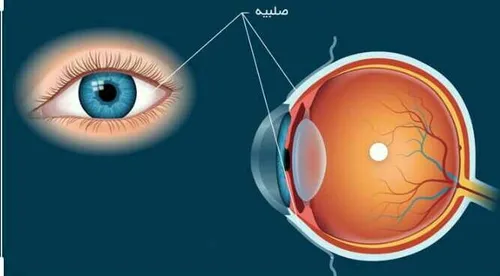 صلبیه یا sclera لایه ای محکم و سفید رنگ از بافت پیوندی اس