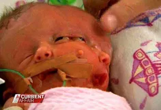 تولد نوزادی با دو چهره