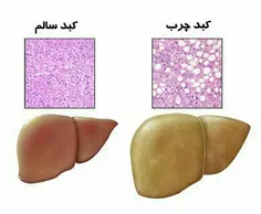 ️%40 ایرانی ها به بیماری کبد_چرب مبتلا هستند.