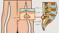 عکس کیست مویی و تصاویر واضح از قبل و بعد از عمل