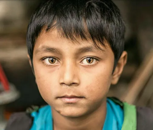 این کودک اهل نپال به یک بیماری ژنتیکی نادر به نام "سندروم