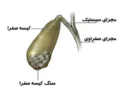 ️اگر سنگ صفرا دارید