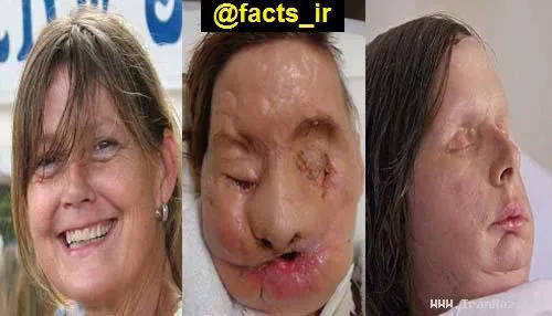 چهره جدید زنی که 2 سال پیش بر اثر حمله یک شامپانزه تمام ا