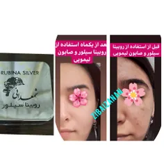 ضد جوش و جای جوش روشن کننده صورت و دورچشم