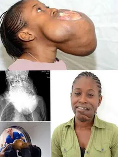 دختری 17 ساله در افریقا با توموری وحشتناک به اندازه یک تو