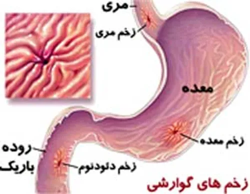 زخم معده !