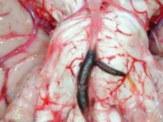 تصویری واقعی از مغز بعد از یک سکته مغزی...