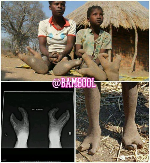 قبیله ای در زیمبابوه که در پاهایشان دو انگشت وجود دارد و 