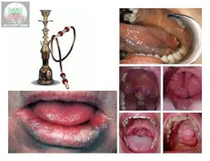 سونامی سرطان دهان در ایران، به علت مصرف "قلیان" و دخانیات