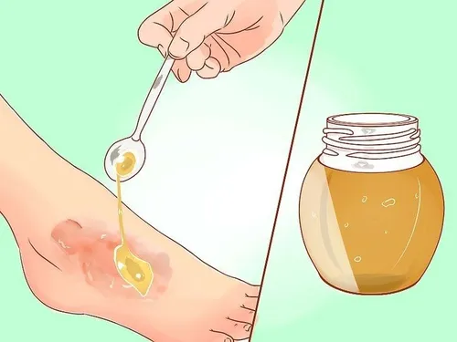 مالیدن مرتب عسل در سوختگیهای سطحی مانع تاول زدن وباعث ترم