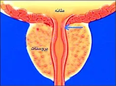 سلام...یکبار دیگه در مورد پروستات پست گذاشته بودم...به دل