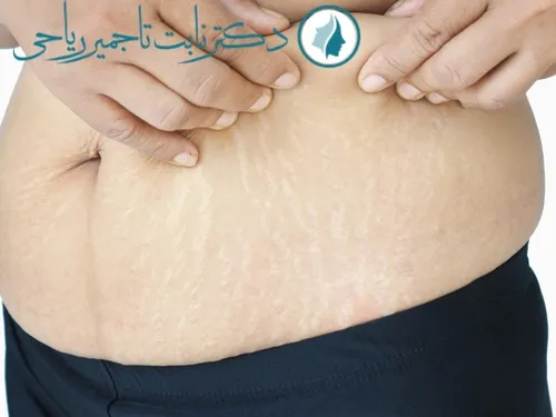 درمان ترک پوستی ناشی از چاقی توسط دکتر نابت تاجمیر ریاحی