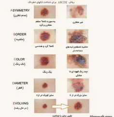 خالبردای زگیل .جراحی مختلف در بیمارستان دولتی شیراز   هرک