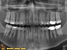 رییس اداره سلامت دهان و دندان وزارت بهداشت: هر ایرانی ۳۵ 