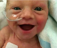 💢 نوزاد پنج روزه دختر که به علت بیماری پره اکلمپسی مادرش 