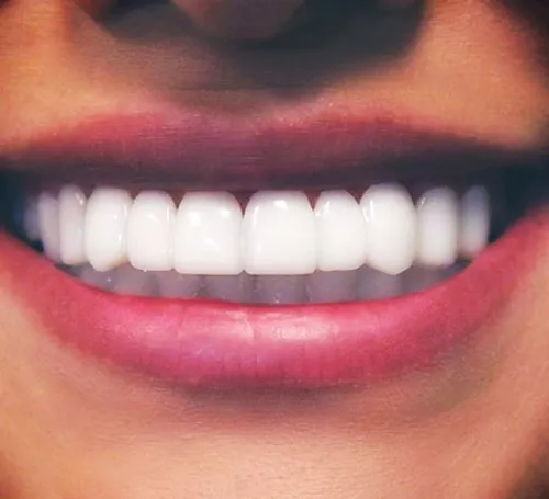 زیبایی دندان ها با ایمپلنت دندان