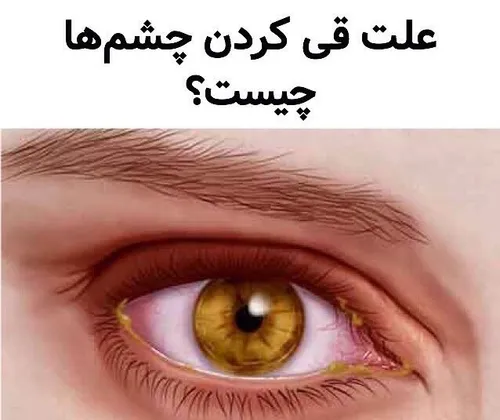 علل قی کردن چشم ها (ترشحات زرد رنگ در گوشه داخلی چشم )🤔