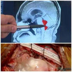 طرف بعد از چند سال سردرد داشتن، رفته دکتر و با انجام MRI 